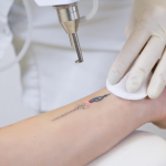Herstellen als een pro: dit doet een dermaroller na je tattoo-laserbehandeling