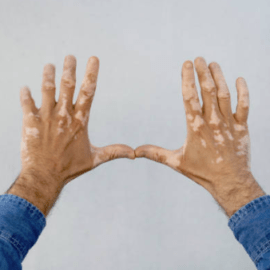 Vitiligo