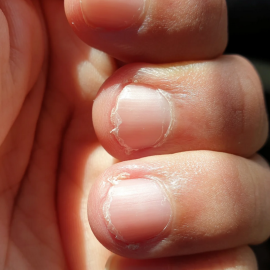 Wat te Doen bij Gespleten Nagels? Oorzaken en Effectieve Oplossingen