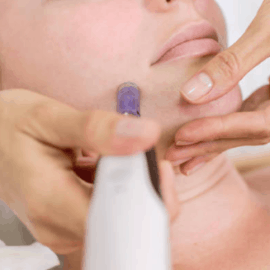 Huidtherapie met de dermastamp