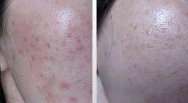 dermaroller-voor-en-na-1