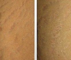 dermaroller-voor-en-na-10-247x207