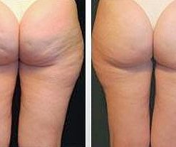 dermaroller-voor-en-na-11-247x207