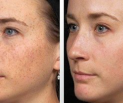 dermaroller-voor-en-na-13-247x208