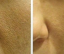 dermaroller-voor-en-na-14-247x209