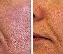 dermaroller-voor-en-na-15-247x212