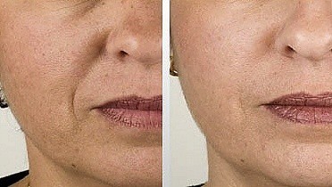 dermaroller-voor-en-na-16