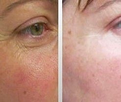 dermaroller-voor-en-na-17-247x209