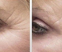 dermaroller-voor-en-na-18-247x210