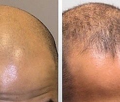 dermaroller-voor-en-na-19-247x210