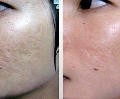 dermaroller-voor-en-na-2-247x205