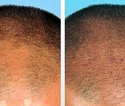 dermaroller-voor-en-na-20-247x209