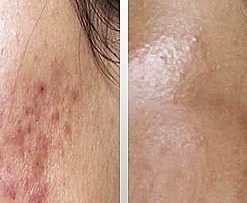 dermaroller-voor-en-na-3-247x203