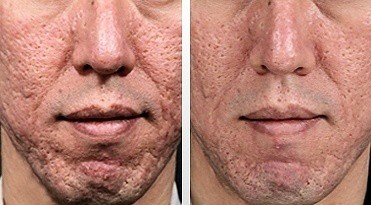 dermaroller-voor-en-na-4