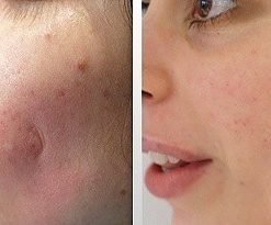 dermaroller-voor-en-na-5-247x205