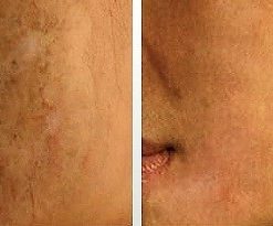 dermaroller-voor-en-na-7-247x205