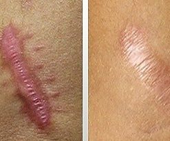 dermaroller-voor-en-na-8-247x205