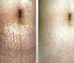 dermaroller-voor-en-na-9-247x210