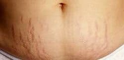 striae